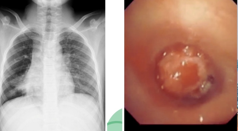 Viêm phổi 4 tháng, nội soi phát hiện u ác tính ở phổi hiếm gặp- Ảnh 1.