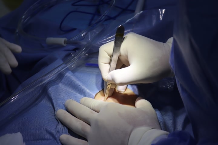 Complications à connaître lors de la réalisation d'une rhinoplastie structurelle utilisant du cartilage costal et du cartilage de l'oreille - 1