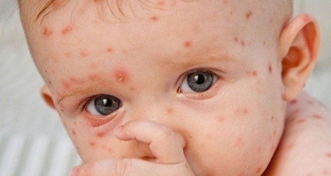 Measles epidemic increased 8 times, Ministry of Health recommends prevention