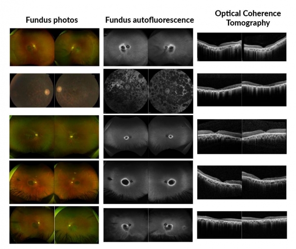 Nuevo descubrimiento de genes relacionados con distrofias de retina