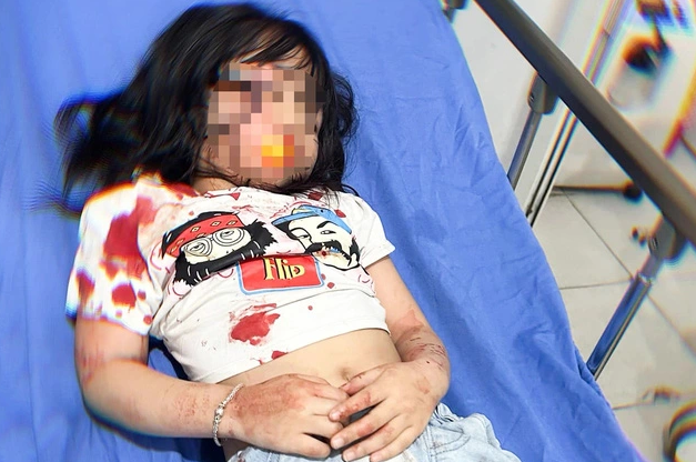 5-year-old girl attacked by dog. Photo: Quynh Dung