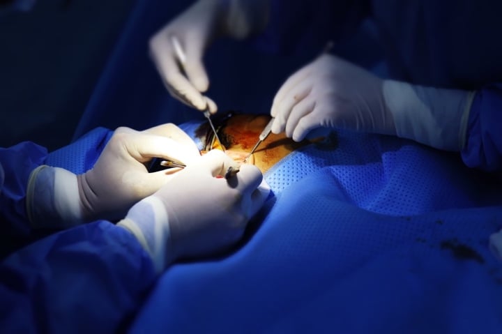 Complications à connaître lors de la réalisation d'une rhinoplastie structurelle utilisant du cartilage costal et du cartilage de l'oreille - 2