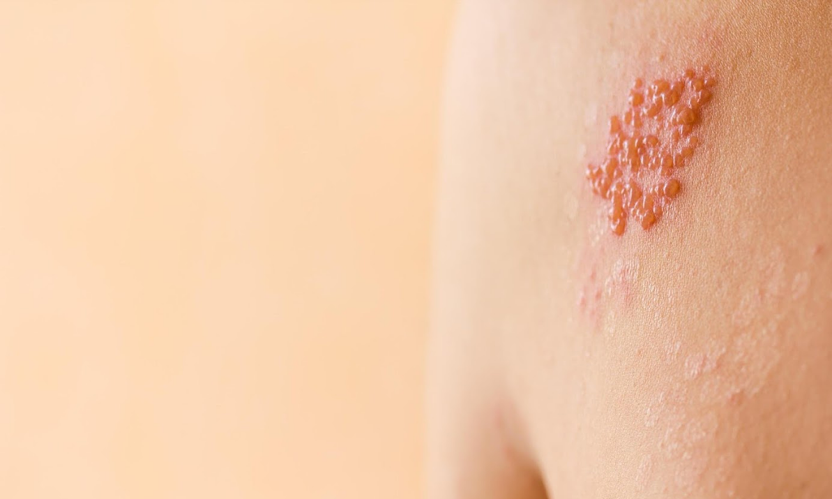 Can people with shingles get chickenpox?