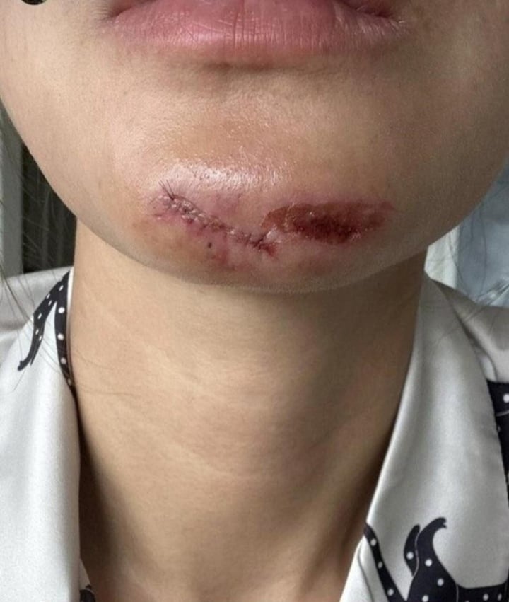 Le mannequin Minh Tu a été frappé au visage par une caméra aérienne et a eu besoin de plus de 10 points de suture - 1