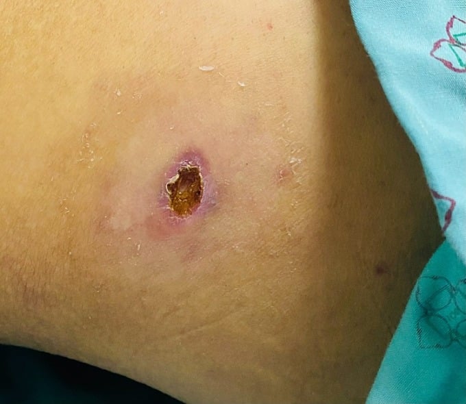 Geschwüre bei einem Patienten mit Tsutsugamushi-Fieber. Foto: Gesundheitsministerium Yen Bai