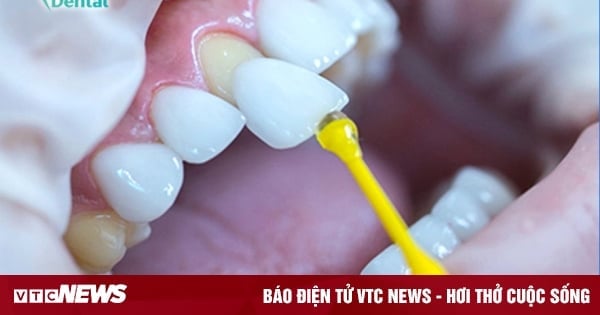 Công nghệ Xsmile - đột phá mới trong bọc răng sứ không mài nhỏ tại Thiên Hà