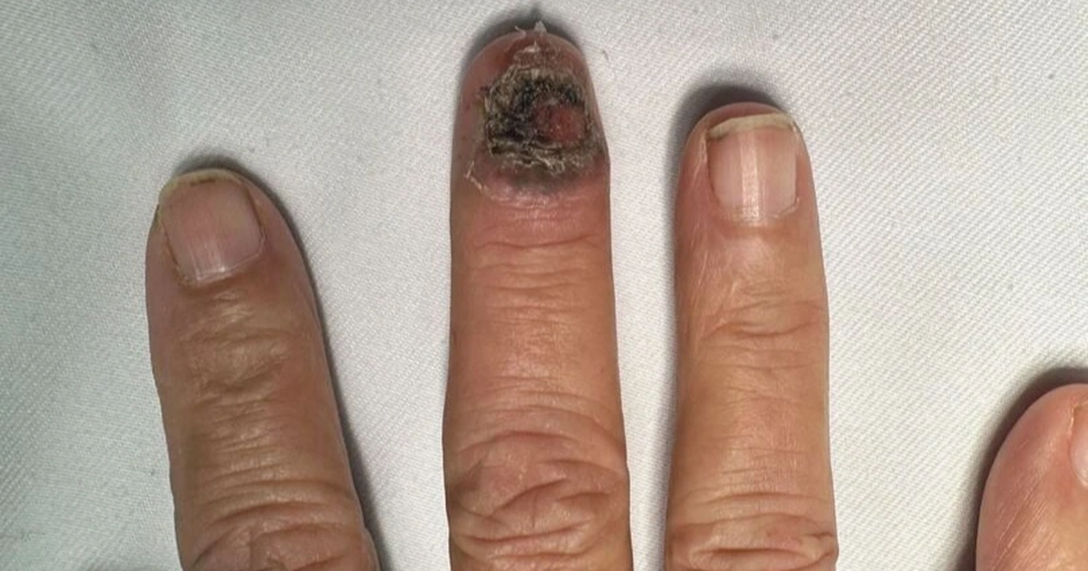 From black nails, detect skin cancer