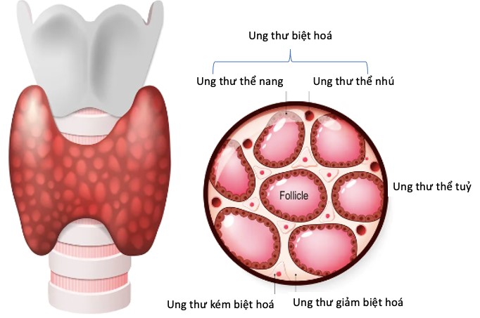 Các dấu hiệu sớm của ung thư tuyến giáp cần biết- Ảnh 2.