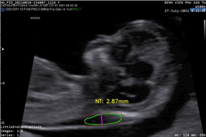 Results of measuring the fetal nuchal translucency from ultrasound images, using AI models. Photo: Character provided