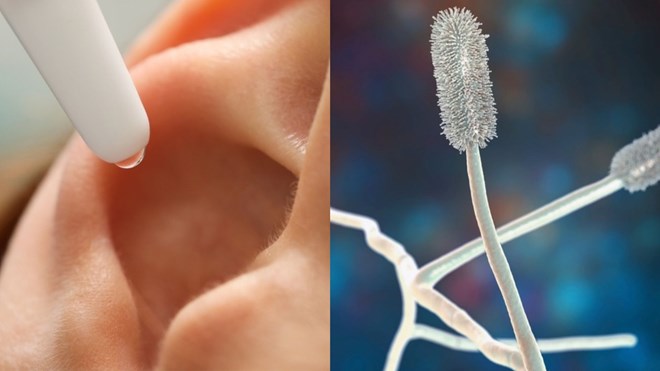 Signes de mycose de l'oreille externe