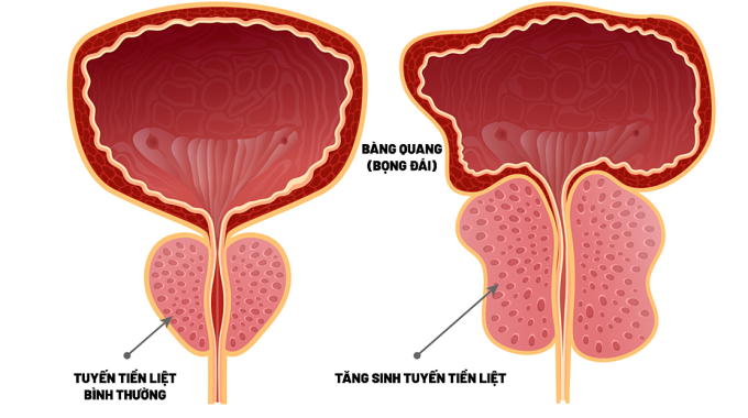 Tăng sinh lành tính tuyến tiền liệt gây rối loạn chức năng tiểu. Ảnh: Bệnh viện cung cấp