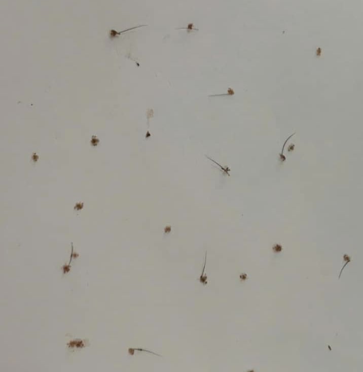 Người phụ nữ 46 tuổi bị rận bám chi chít ở mi mắt, cảnh báo thói quen trong sinh hoạt nhiều người hay gặp phải- Ảnh 1.