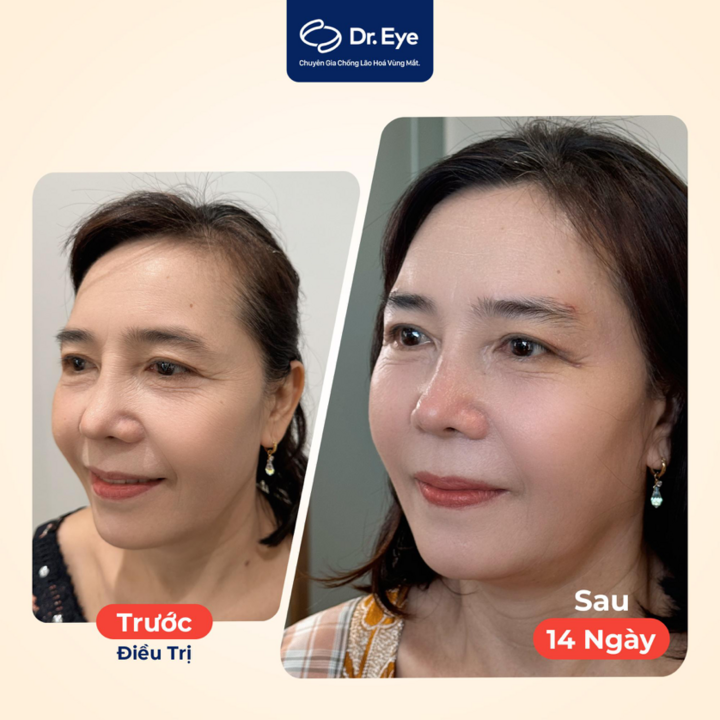 Fotografías de antes y después de 2 semanas de la Sra. Kieu, una clienta que se realizó un levantamiento de cejas con hilo en el Dr. Eye.