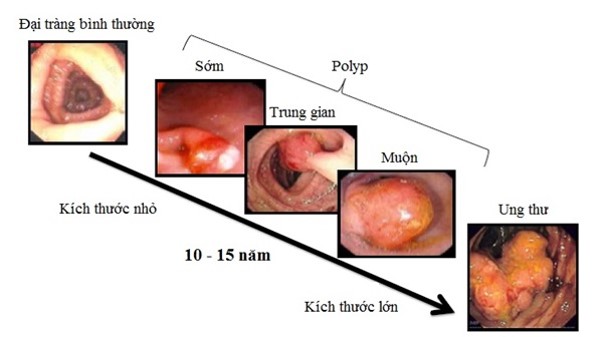 Người đàn ông ở Phú Thọ phát hiện mắc ung thư trực tràng từ một dấu hiệu nhiều người Việt bỏ qua- Ảnh 2.