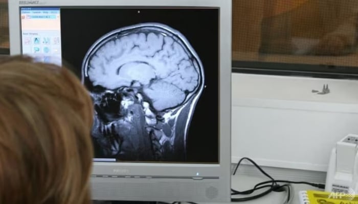 Des médecins trouvent une aiguille dans le cerveau d'une femme de 80 ans en Russie