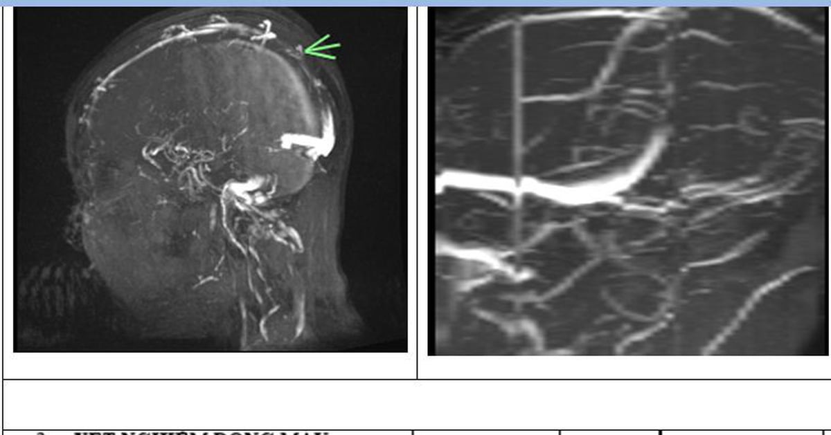 Tuve dolor de cabeza durante 4 días y fui al hospital para descubrir que tenía un tipo especial de accidente cerebrovascular.