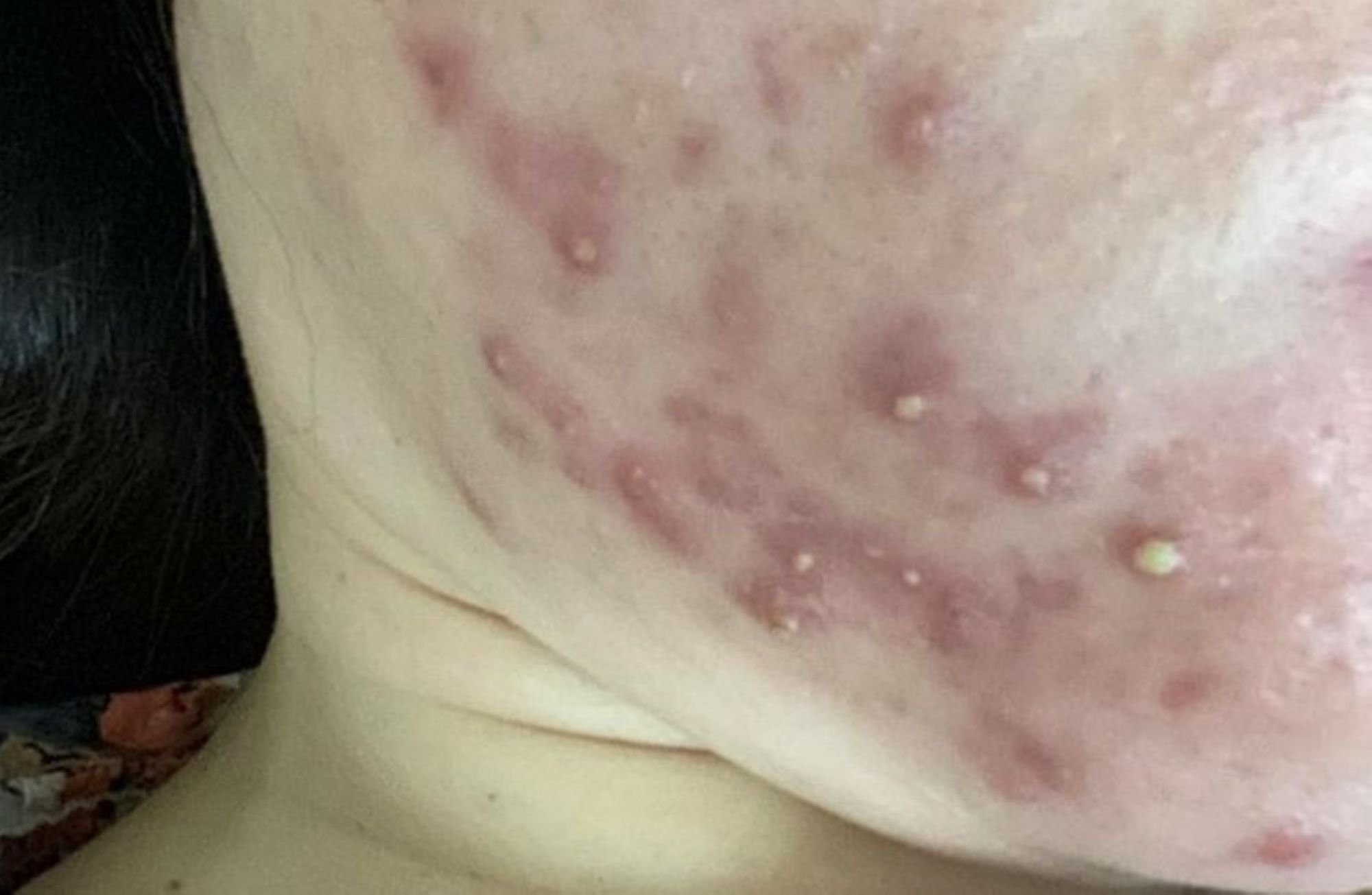La piel de un paciente tiene pústulas, está fina e irritada después de una exfoliación casera. Foto: proporcionada por el hospital
