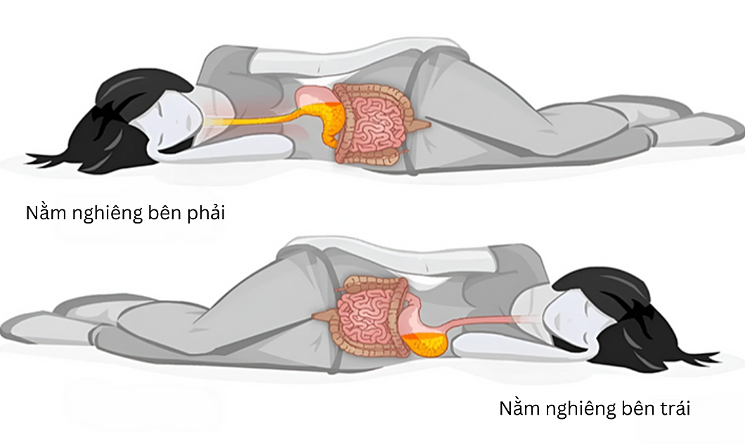 Tư thế ngủ giúp giảm khó tiêu, trào ngược