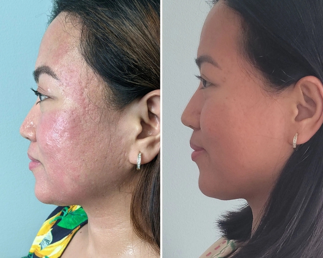 'Cứu' làn da bị sẹo lõm với công nghệ RF Microneedling- Ảnh 4.