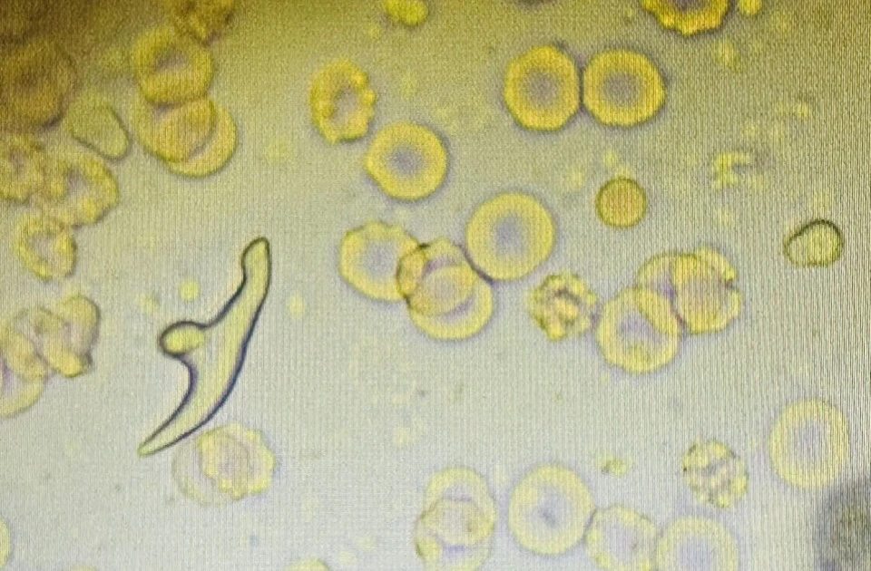 A man was infected with a very rare parasitic dog tapeworm larvae in his lungs.