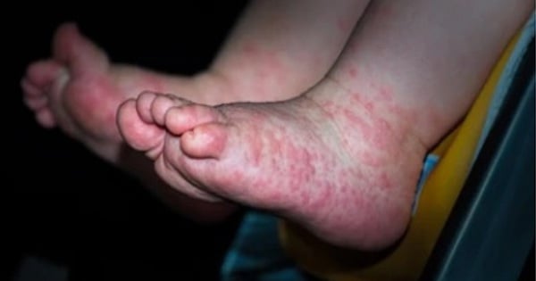 5 keys to help prevent hand, foot and mouth disease in children