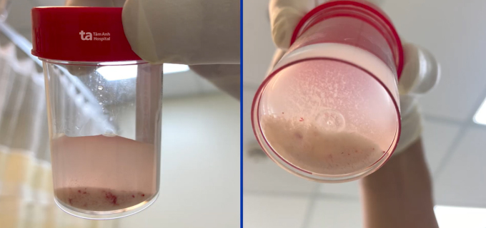 La calcification est dissoute et aspirée hors du corps du patient. Photo : Hôpital général de Tam Anh