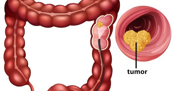 Descubren que una fruta jugosa podría prevenir el cáncer colorrectal