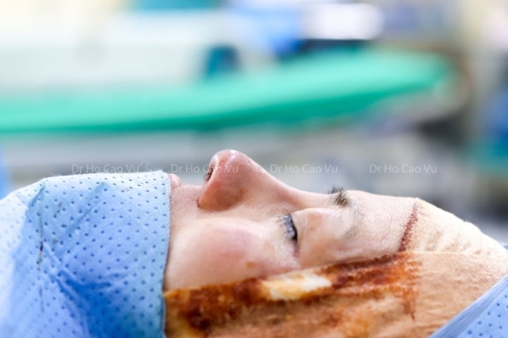 Complications à connaître lors de la réalisation d'une rhinoplastie structurelle utilisant du cartilage costal et du cartilage de l'oreille - 4