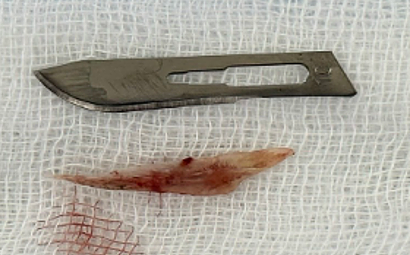 A piece of perch bone after being removed from the patient's body. Photo: Provided by the hospital