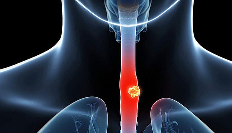 Tumor removal prevents esophageal cancer risk