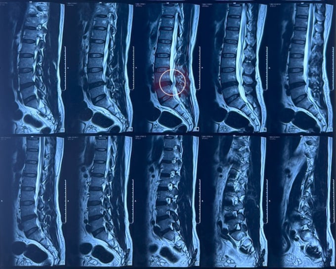 Hình ảnh chụp MRI cho thấy vị trí thoát vị đãi đệm chèn ép thần kinh. Ảnh: Bệnh viện Đa khoa Tâm Anh