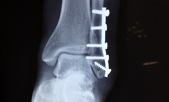 Do I need to remove the screws after the bone heals?