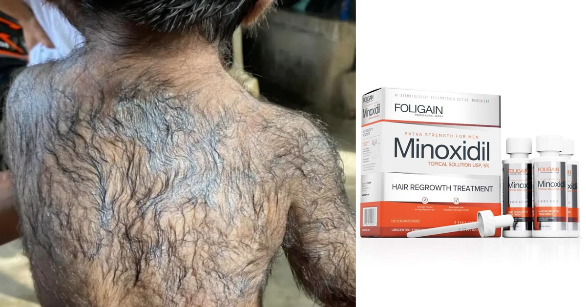 Padre usa medicamento para el crecimiento del cabello y recién nacido se convierte en 'hombre lobo'