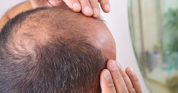 Warum kann das Auszupfen grauer Haare zu Kahlheit führen?