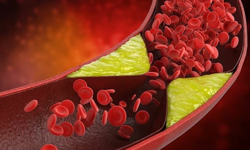 Vì sao cholesterol tăng? - VnExpress Sức khỏe