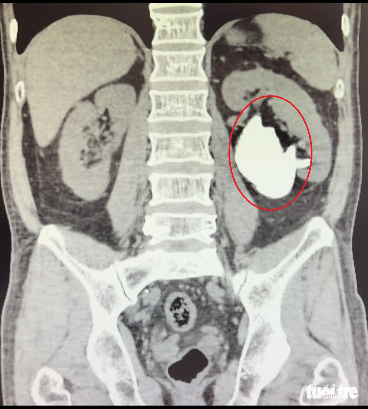 Hình ảnh chụp CT Scan viên sỏi san hô có kích thước 