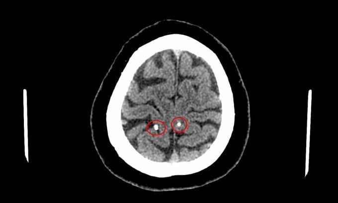 The scan results revealed parasitic cysts in the brain. Photo: Provided by the hospital