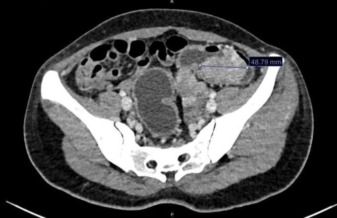 Im CT-Scan ist ein etwa 5 cm großer Tumor im Dickdarm zu sehen. Foto von : Hospital provided