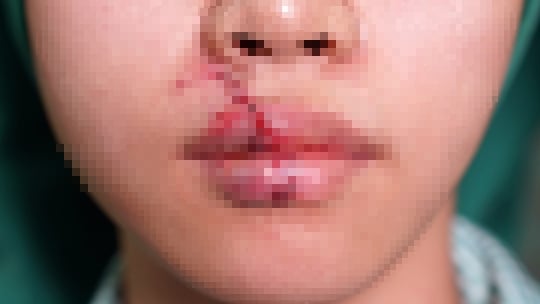 Vá môi rách toạc của cô gái bị thú cưng tấn công - Ảnh 1.