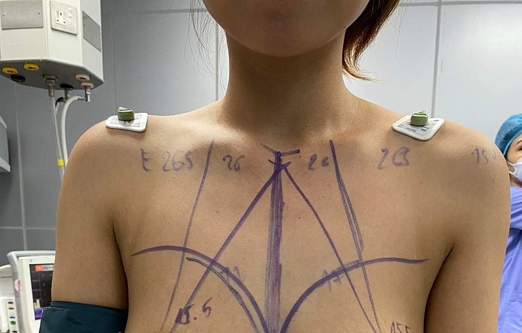 Complications after 4 years of breast augmentation filler injection