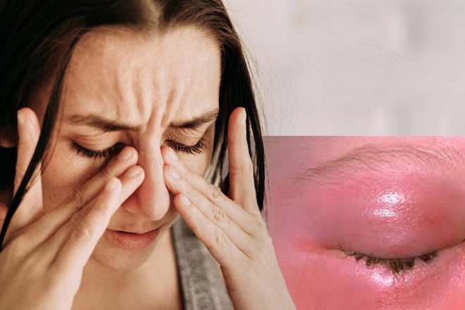 Comment la cellulite affecte-t-elle l’œil ?