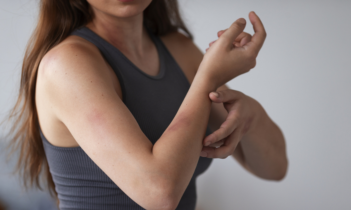 How to quickly relieve itching from mosquito bites?