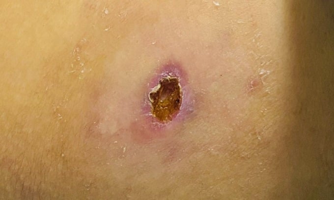 ダニに刺された。写真：病院提供