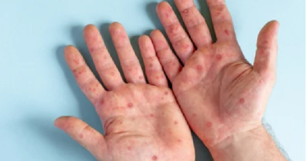 18/20 monkeypox cases infected with HIV, 2 cases progressed severely