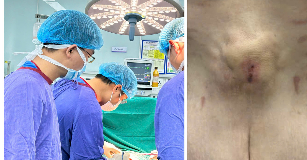 Deformed belly after spending more than 100 million on liposuction