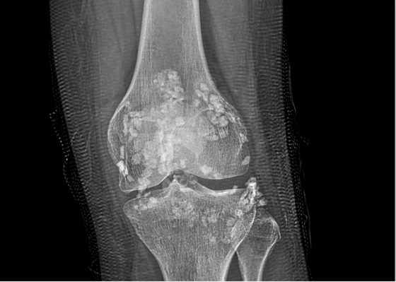 Arthroskopie zur Entfernung von über 100 Steinen aus dem Kniegelenk einer Patientin, Foto 1