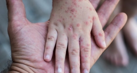 Why has the number of measles cases in Ho Chi Minh City increased recently?