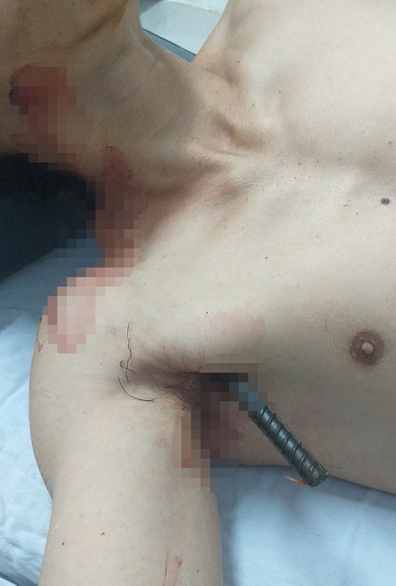 Surgery to save young man impaled by 2 iron bars photo 1