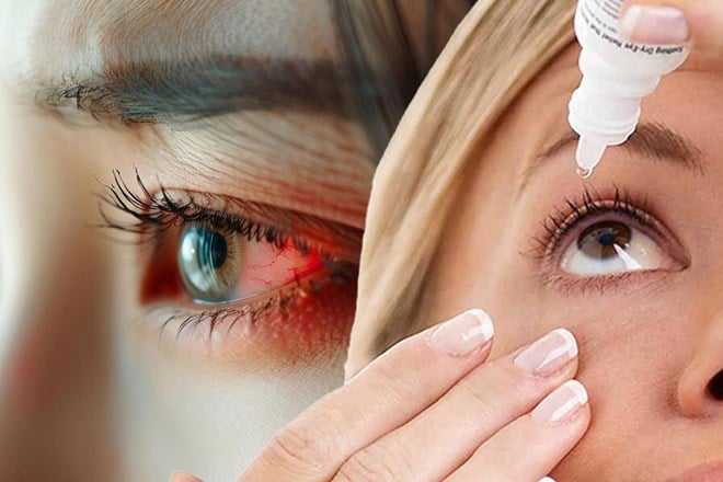 ما هو سبب احمرار العينين عند الاستيقاظ؟
