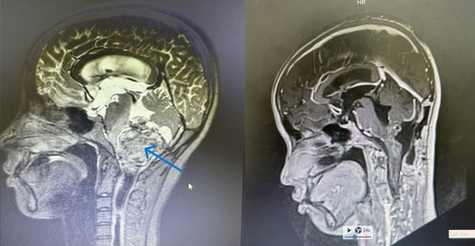 Imágenes del tumor en el tronco encefálico (izquierda) y después de extirparlo quirúrgicamente (derecha). Foto: proporcionada por el hospital